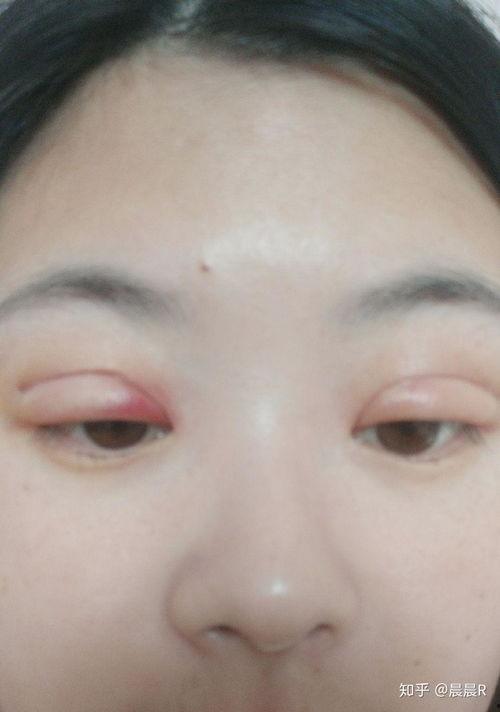 双眼皮埋线视频全过程,从术前准备到术后恢复