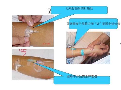 留置针操作视频,轻松掌握静脉穿刺技巧