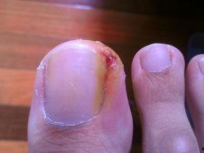 修甲沟炎的视频,告别疼痛困扰