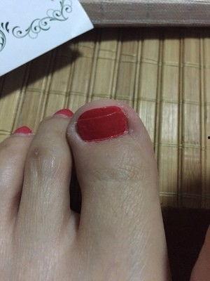 修甲沟炎的视频,告别疼痛困扰