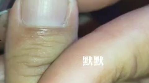 修甲沟炎的视频,告别疼痛困扰